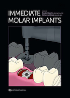 Immediate Molar Implants Kindle Edition | ایمپلنت مولر فوری
